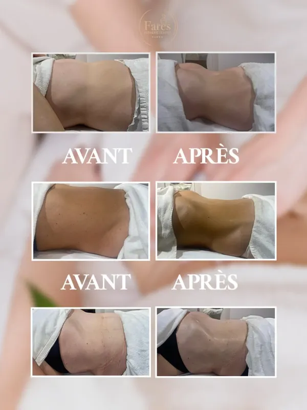 Résultat Amincissement Avant Après 1