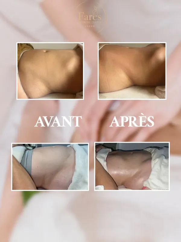 Résultat Amincissement Avant Après 2