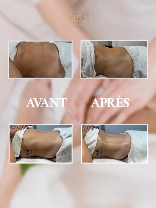 Résultat Amincissement Avant Après 4